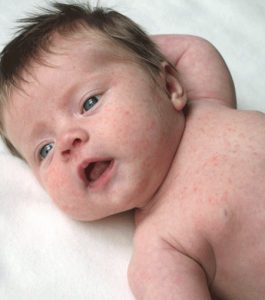 Крапивница у детей как и чем лечить