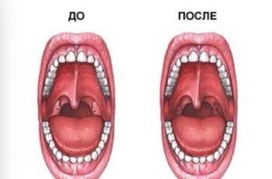 Операция по удалению аденоидов до и после