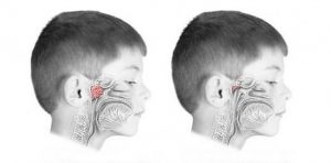 Удаление аденоидов у ребенка
