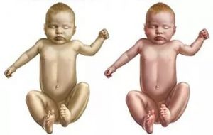 желтушка у новорожденных